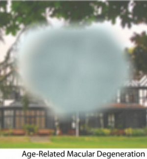Wet AMD Visual
